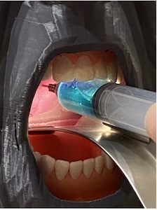 A peritonsillar abscess drainage using 3D printed models