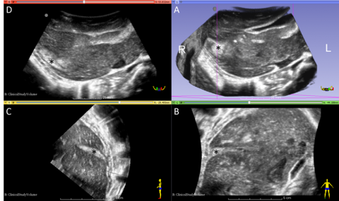 3D Ultrasound